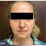 Rhinoplasty Before & After Patient #793