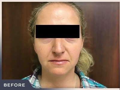 Rhinoplasty Before & After Patient #793