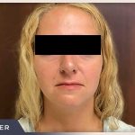 Rhinoplasty Before & After Patient #793