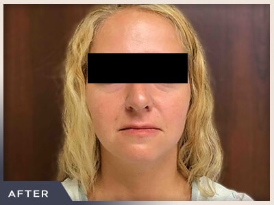 Rhinoplasty Before & After Patient #793
