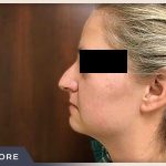 Rhinoplasty Before & After Patient #793