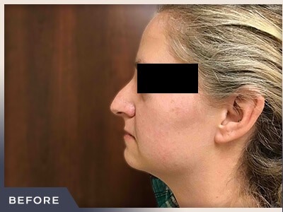 Rhinoplasty Before & After Patient #793
