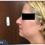 Rhinoplasty Before & After Patient #793