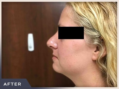 Rhinoplasty Before & After Patient #793