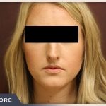 Rhinoplasty Before & After Patient #792