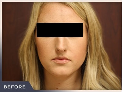 Rhinoplasty Before & After Patient #792
