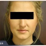 Rhinoplasty Before & After Patient #792