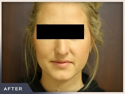 Rhinoplasty Before & After Patient #792