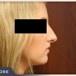 Rhinoplasty Before & After Patient #792