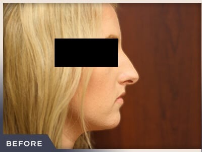 Rhinoplasty Before & After Patient #792