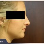 Rhinoplasty Before & After Patient #792