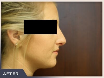 Rhinoplasty Before & After Patient #792