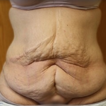 Massive Weight Loss Before & After Patient #781