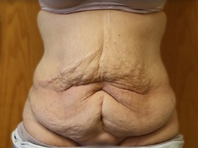 Massive Weight Loss Before & After Patient #781