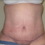 Massive Weight Loss Before & After Patient #781