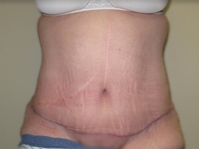 Massive Weight Loss Before & After Patient #781