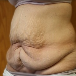Massive Weight Loss Before & After Patient #781