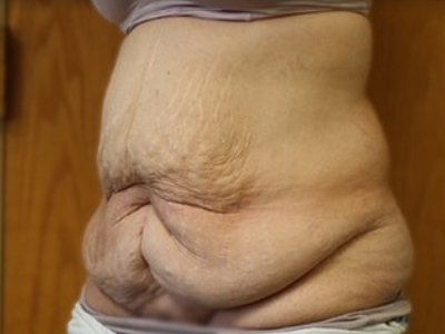 Massive Weight Loss Before & After Patient #781