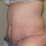 Massive Weight Loss Before & After Patient #781