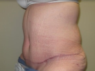 Massive Weight Loss Before & After Patient #781