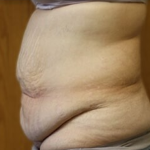 Massive Weight Loss Before & After Patient #781