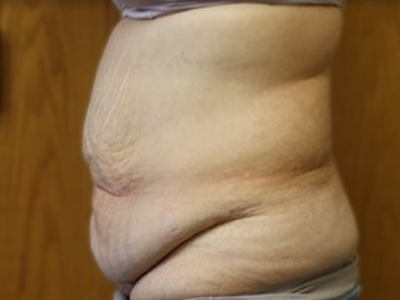 Massive Weight Loss Before & After Patient #781