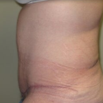Massive Weight Loss Before & After Patient #781