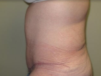 Massive Weight Loss Before & After Patient #781