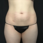Mommy Makeover Before & After Patient #1587
