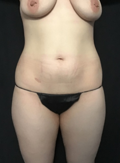 Mommy Makeover Before & After Patient #1587