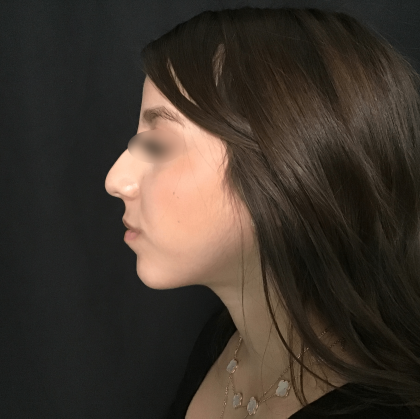 Rhinoplasty Before & After Patient #1622