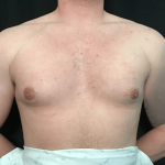 Gynecomastia Before & After Patient #1570