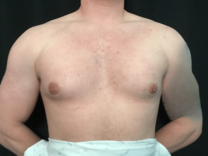 Gynecomastia Before & After Patient #1570
