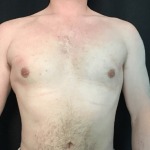 Gynecomastia Before & After Patient #1570
