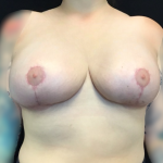 Breast Reduction Before & After Patient #1561