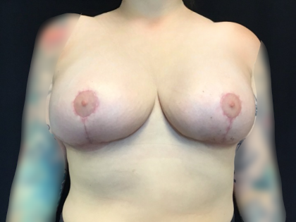 Breast Reduction Before & After Patient #1561