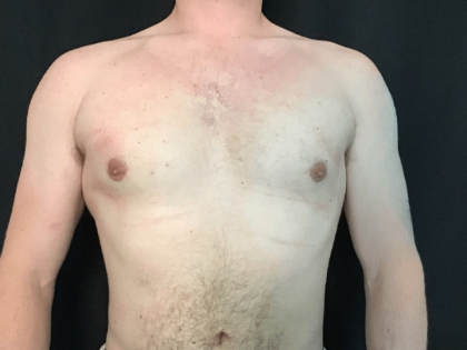 Gynecomastia Before & After Patient #1570