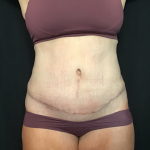 Mommy Makeover Before & After Patient #1601