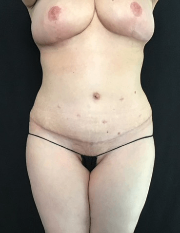 Mommy Makeover Before & After Patient #1615