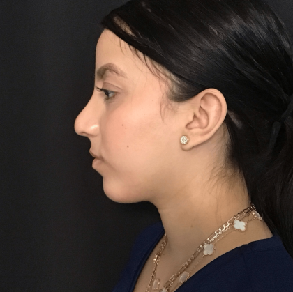 Rhinoplasty Before & After Patient #1622