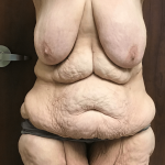 Circuferential Body Lift Before & After Patient #1625