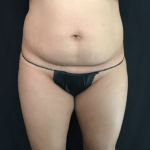 Mini Tummy Tuck Before & After Patient #1580