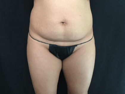 Mini Tummy Tuck Before & After Patient #1580