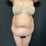 Mommy Makeover Before & After Patient #1595