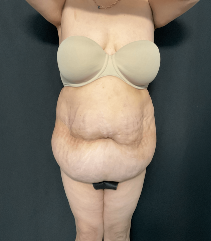 Mommy Makeover Before & After Patient #1595