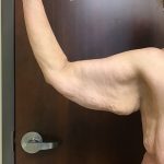 Brachioplasty Before & After Patient #1486