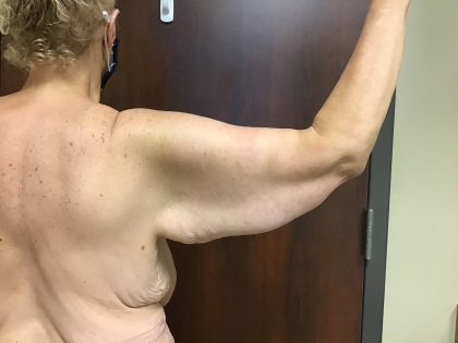 Brachioplasty Before & After Patient #1486