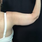 Brachioplasty Before & After Patient #1486