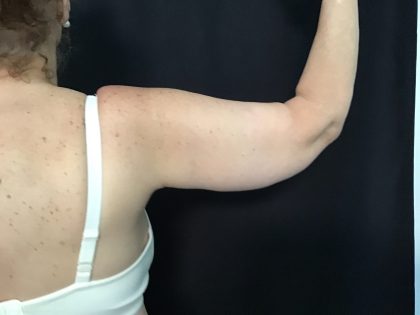 Brachioplasty Before & After Patient #1486