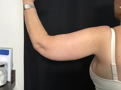 Brachioplasty Before & After Patient #1486